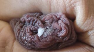 Immense Phimosis Being Extracted Cum and Précum.